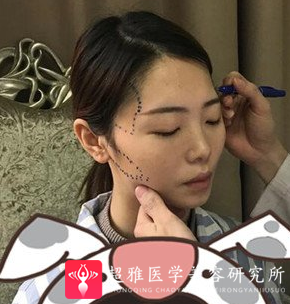 自体脂肪填充术