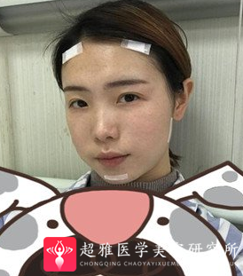 自体脂肪填充术
