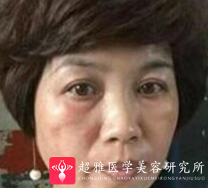 面部提升术