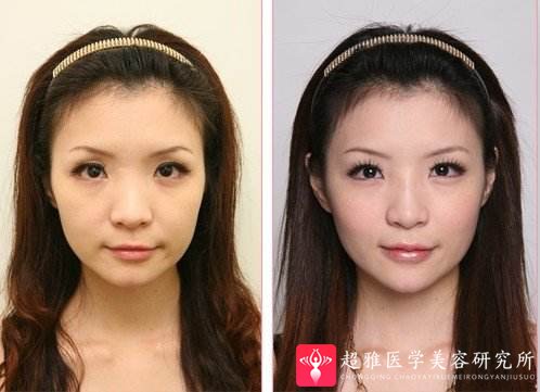 隆鼻手术