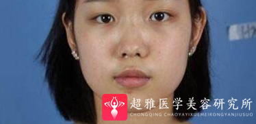 隆鼻手术