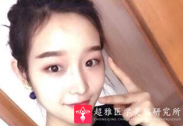 隆鼻手术