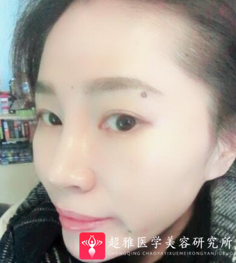 面部提升术