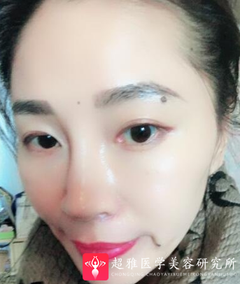 面部提升术