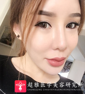 面部提升术