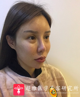 面部提升术