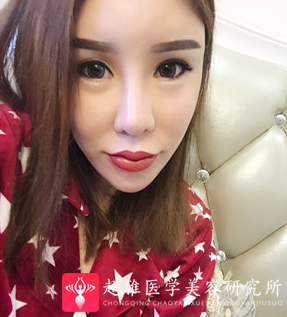 面部提升术