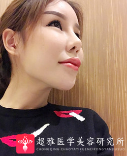 面部提升术