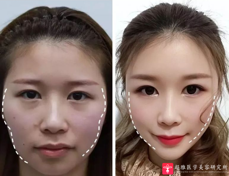 自体脂肪填充术
