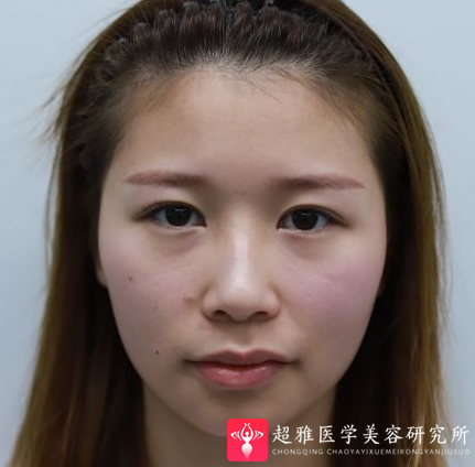 自体脂肪填充术