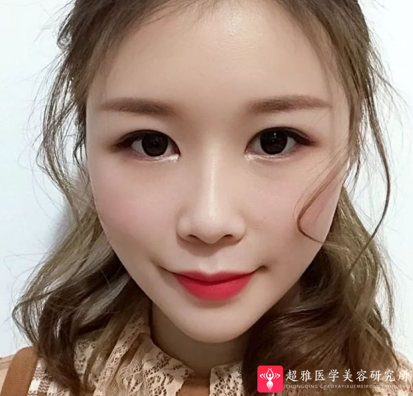 自体脂肪填充术