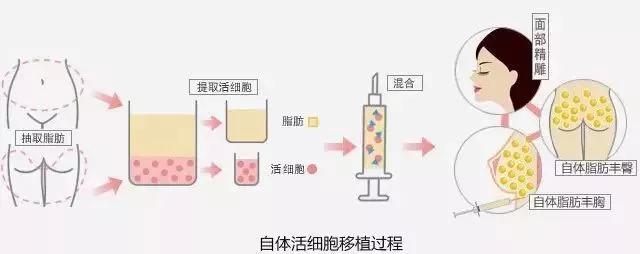 自体脂肪填充术