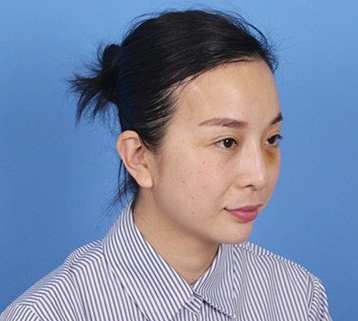 面部提升术