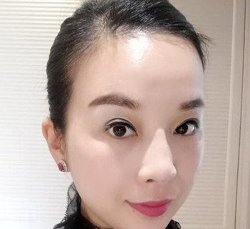 面部提升术