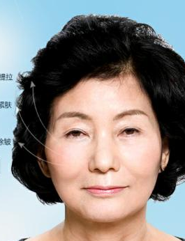 面部提升术