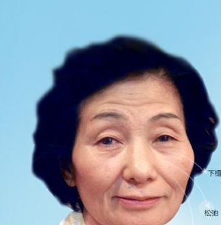 面部提升术