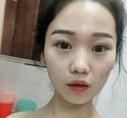 不开刀下巴延长术