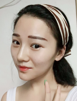 不开刀下巴延长术