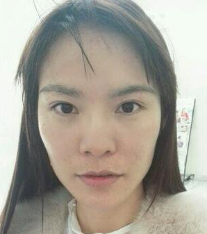 自体脂肪填充术