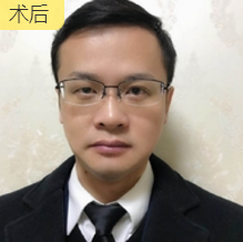 面部提升术