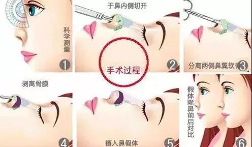 隆鼻手术