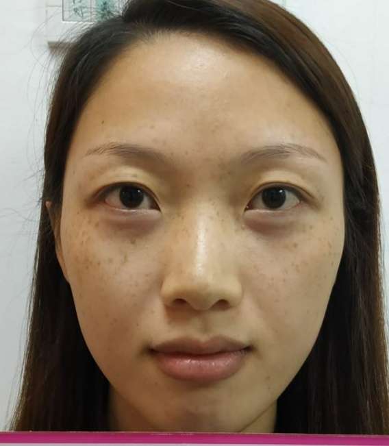 不开刀下巴延长术