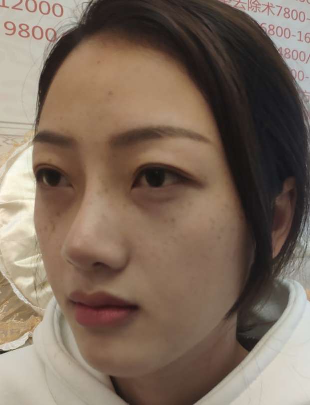 不开刀下巴延长术