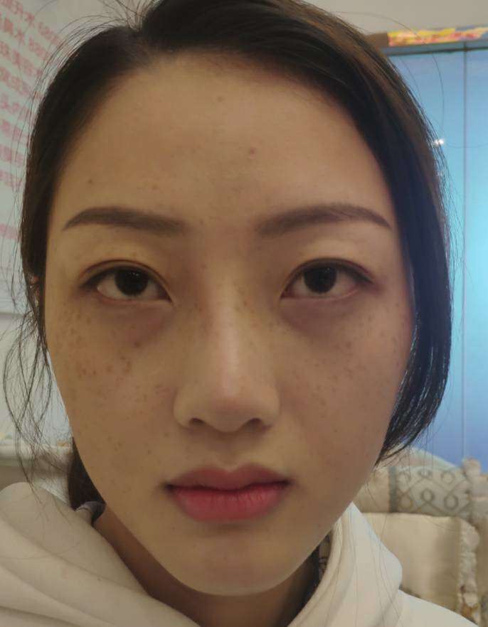 不开刀下巴延长术