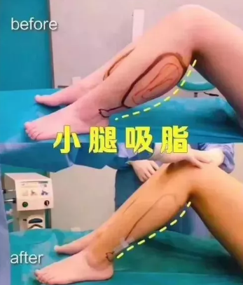 自体脂肪填充术