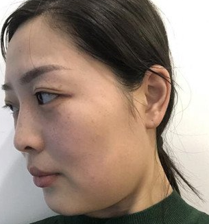 超声波瘦脸