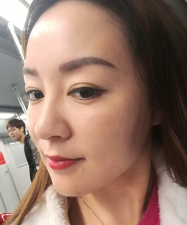 面部提升术