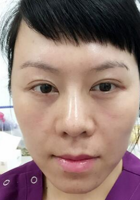 面部提升术