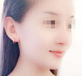 隆鼻手术