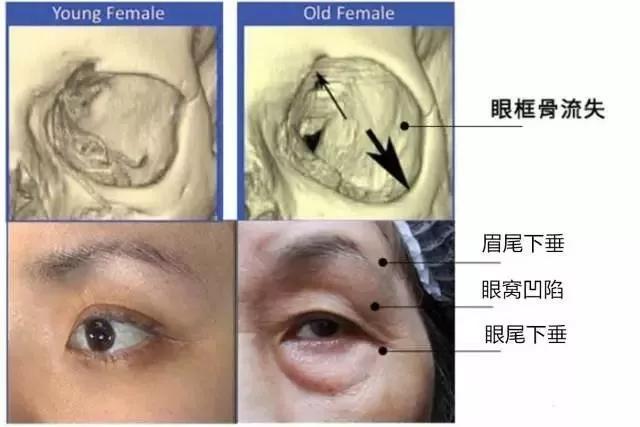 自体脂肪填充术