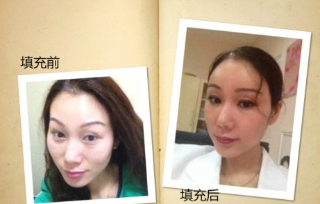 自体脂肪填充术