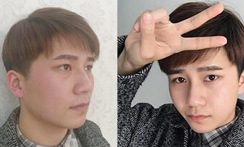 超声波瘦脸
