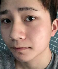 超声波瘦脸