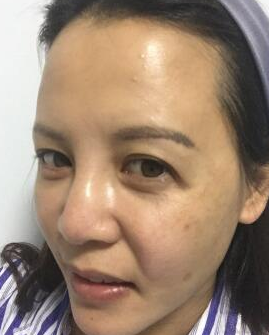 面部提升术