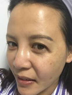 面部提升术