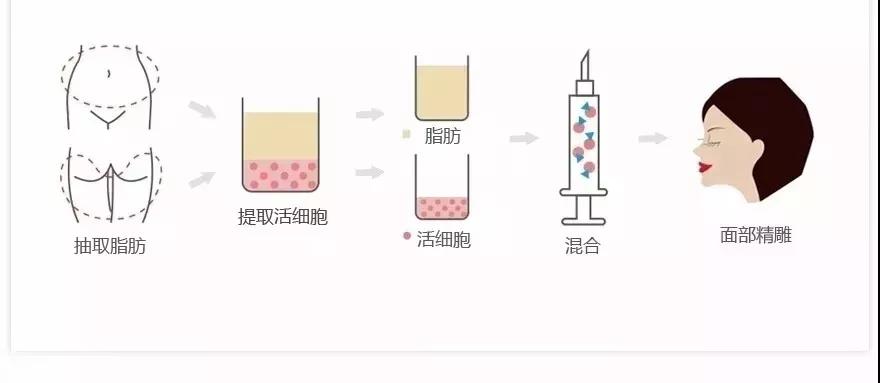自体脂肪填充术