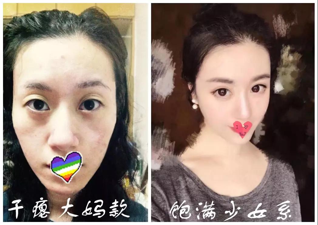 自体脂肪填充术