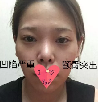 自体脂肪填充术