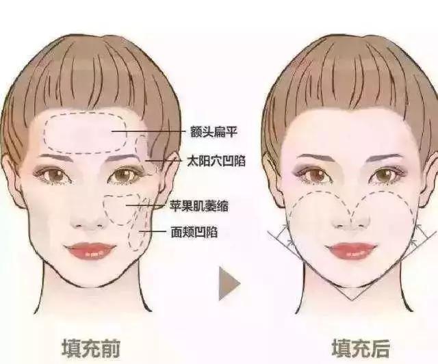 自体脂肪填充术