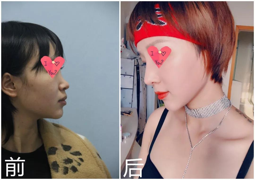隆鼻手术