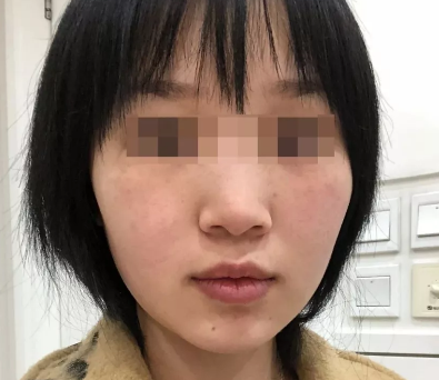 隆鼻手术