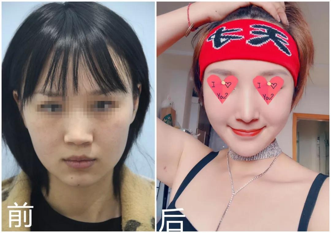隆鼻手术