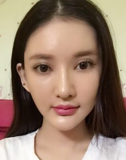 面部提升术