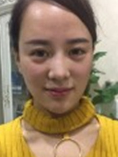 面部提升术