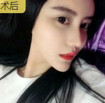 隆鼻手术