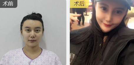 隆鼻手术